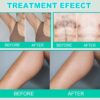 Sterilized Electrolysis Needles for Professional Hair Removal Device