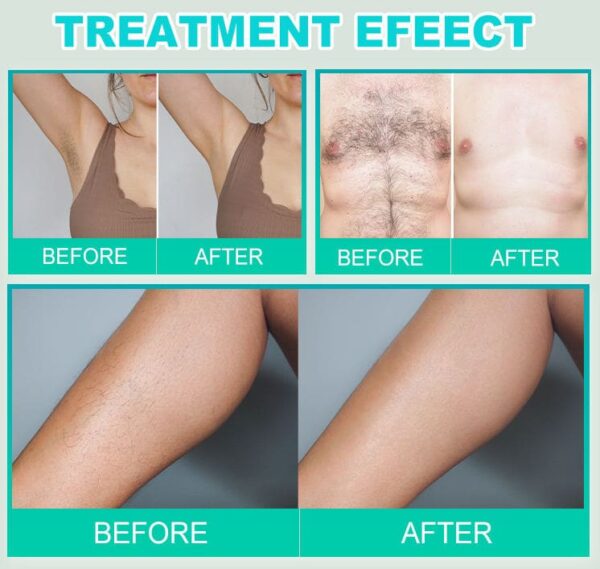 Sterilized Electrolysis Needles for Professional Hair Removal Device